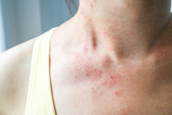 eczema